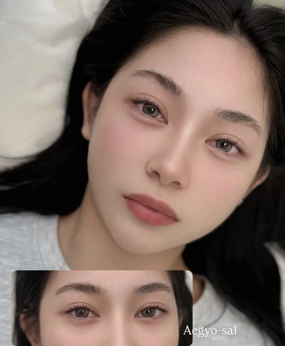 립 시술과 애교살 반영구를 함께 받은 고객 사례