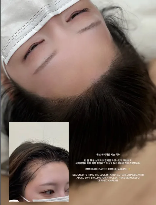 헤어라인 — 헤어라인 반영구