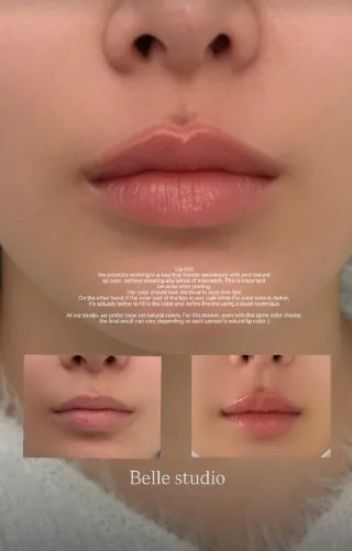 인중 쉐이딩 — 포인트 시술