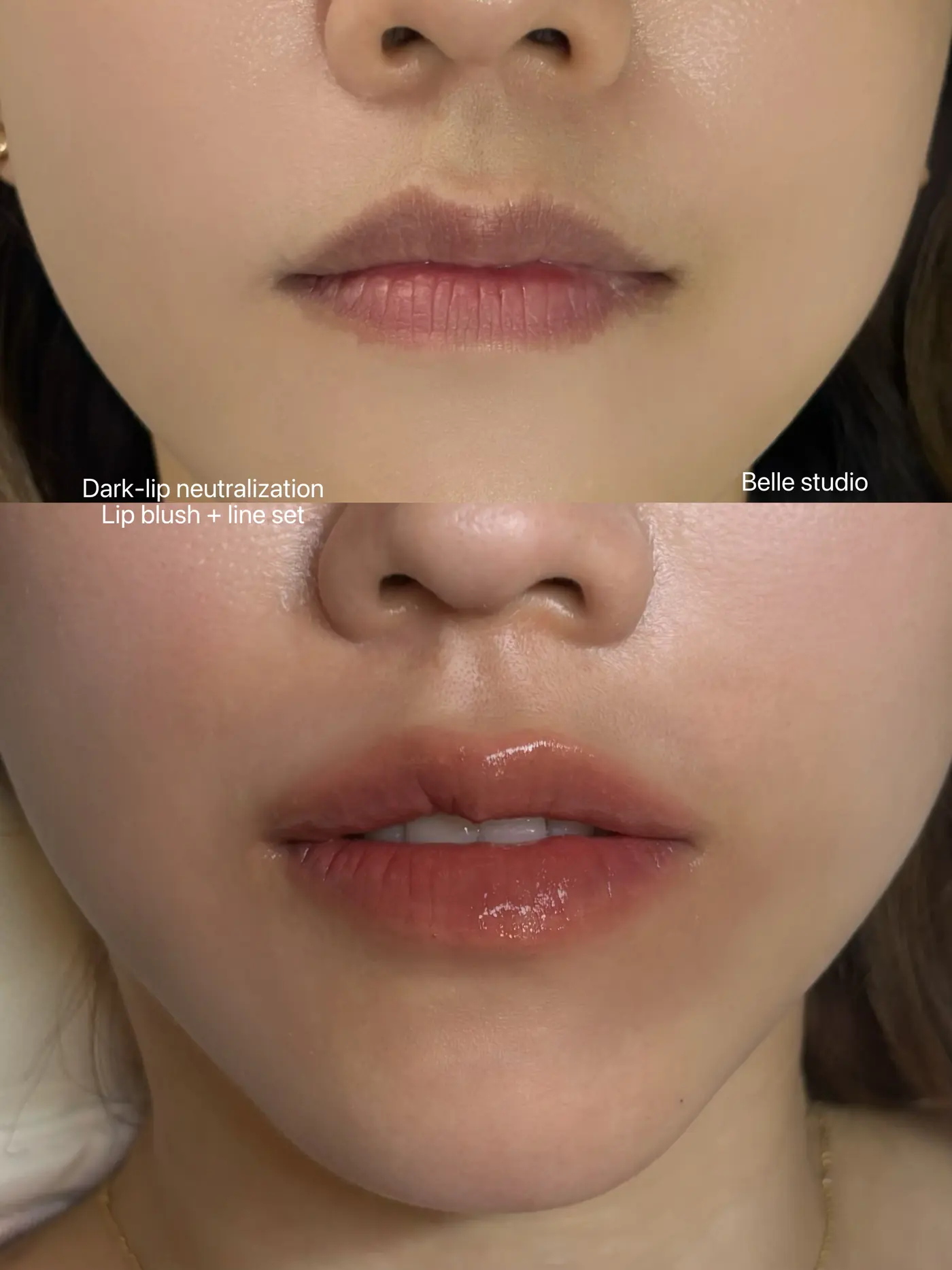 다크립 중화 전후 비교 — 어두운 색소를 단계적으로 정돈한 사례